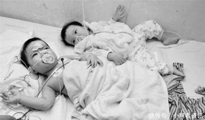 妹妹张珑|连体姐妹做分离手术时,共有器官给了姐姐,10年后妹妹怎么样了