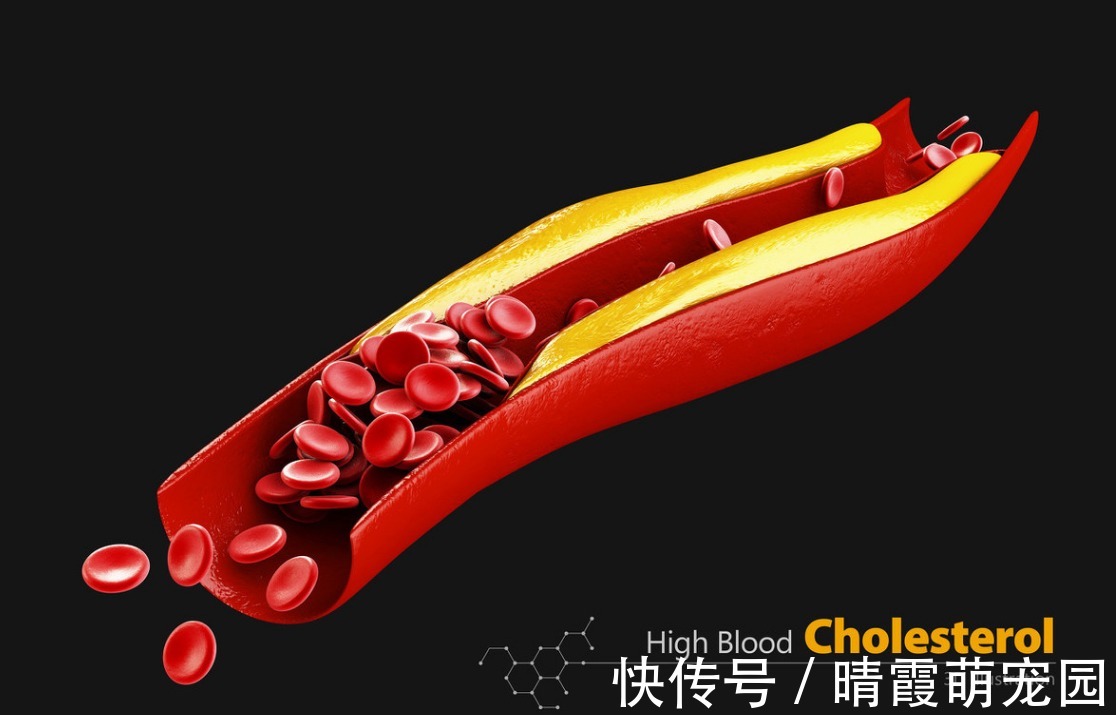 脂肪肝|高血脂降不下来?1简单小招,不到1个月,血脂就降了、血管干净