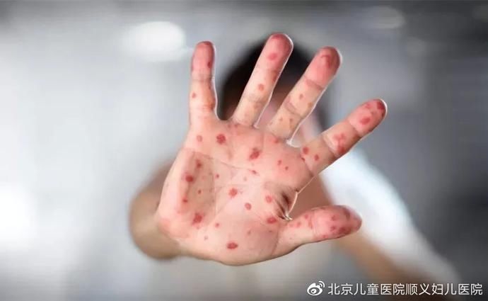 病毒|带你了解手足口病