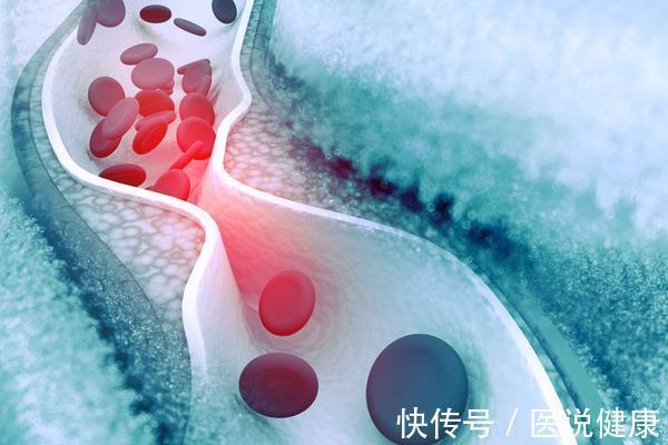 熬夜|平时爱做4件事的人,可能是脑梗“候选人”!若你有,及时改正