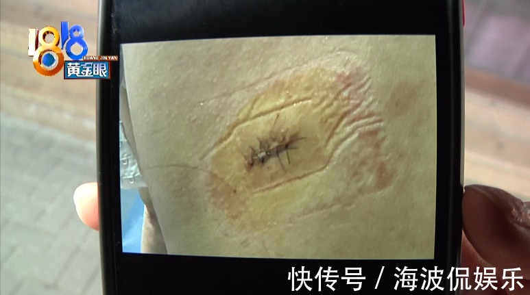 姑娘|吸脂术探头留在姑娘体内,院方两次手术都没取出