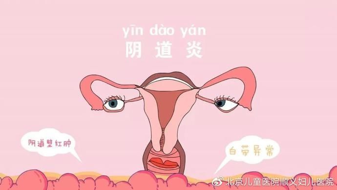 阴道炎|呵护女性私密健康 远离难言之隐的阴道炎