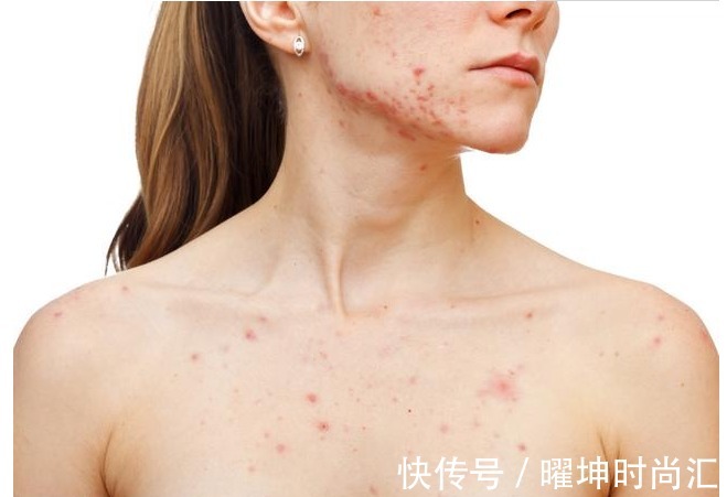 消化道出血|肝不好的人,上厕所通常会有3种表现,若没有,恭喜你肝很健康