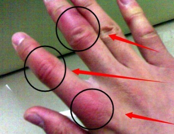 中医|“冻疮”是冬天极为常见的皮肤病,怎么去治疗冻疮呢中医有妙招