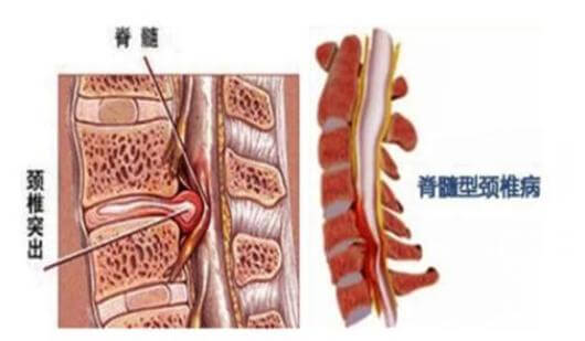 压迫|颈椎病病发,身体将发出5个“信号”,如患上需及时治疗