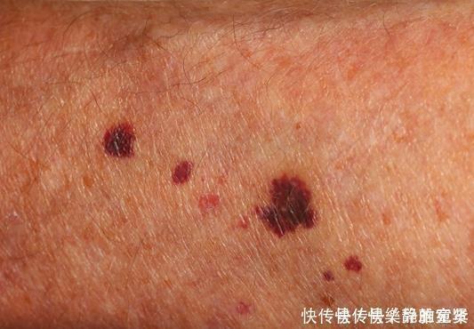 皮肤过敏|皮肤出现四种异常,别傻傻的认为是皮肤过敏,有可能是肝病的前兆