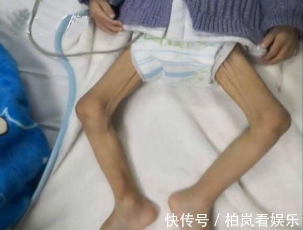 消瘦|因为一时疏忽，出生时8.8斤的宝宝一个月后骨瘦如柴，家长要警惕