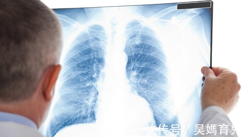 切除|体检结果显示有肺结节，严重吗？确诊肺结节，要马上切除吗？