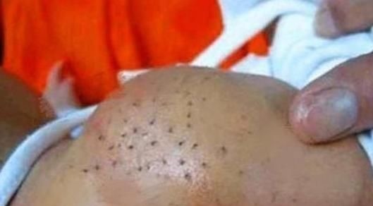 拔掉|宝宝身上长“小黑虫”,妈妈用心一颗颗拔掉,不料孩子被送去抢救