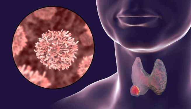 甲状腺癌来之前，可能会通过三个信号及时通知你，错过的人会后悔