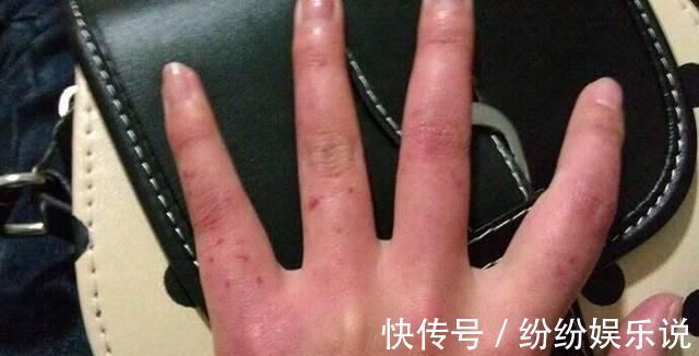 酒精肝|生殖系统发出的这3个信号,说明你的肝可能有问题了