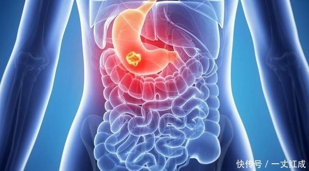 胃病|消化科主任:治胃病超简单,1种“饮料”连喝1月,清幽门除胃病