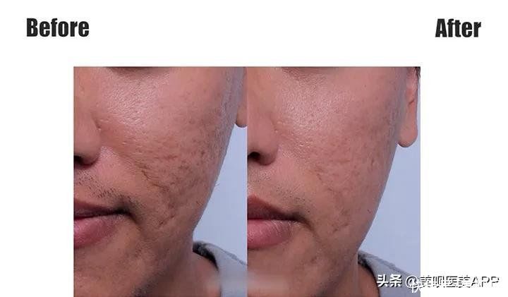 爱豆们竞当医美达人？男性适合的轻医美项目top5合集