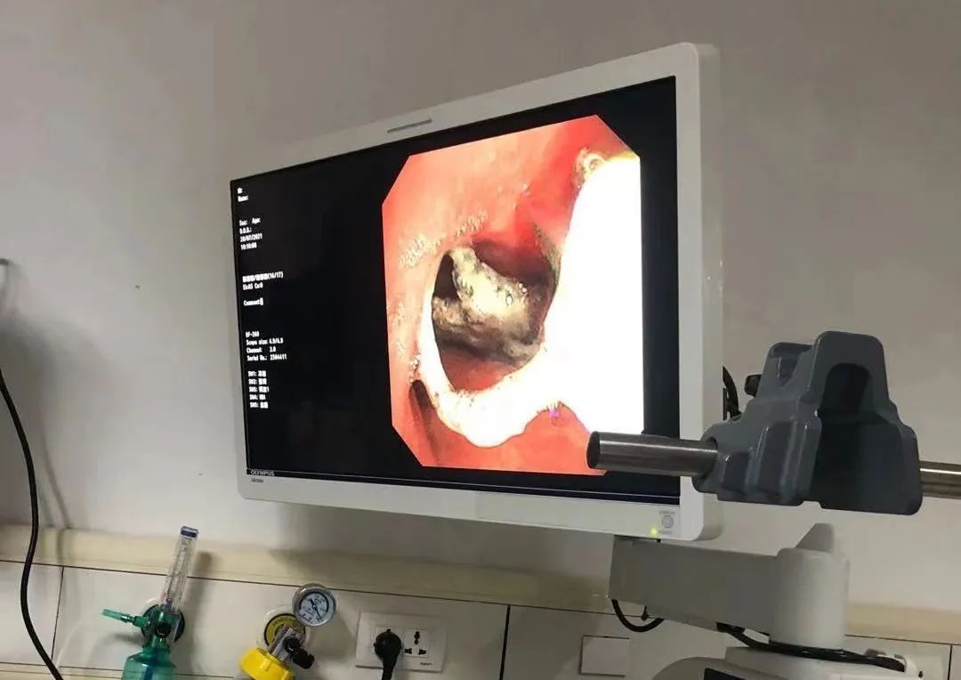 支气管|消失的假牙钩在气管上,杭州大伯“心肺都要咳出来”!这些动作不要再做了!