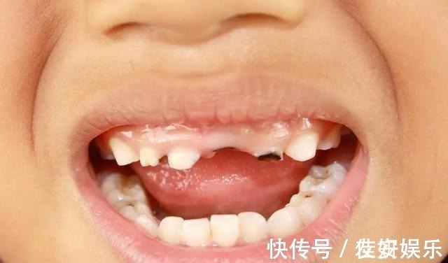 龋齿|4岁男孩牙齿几乎全黑6岁前，不要让孩子自己刷牙！