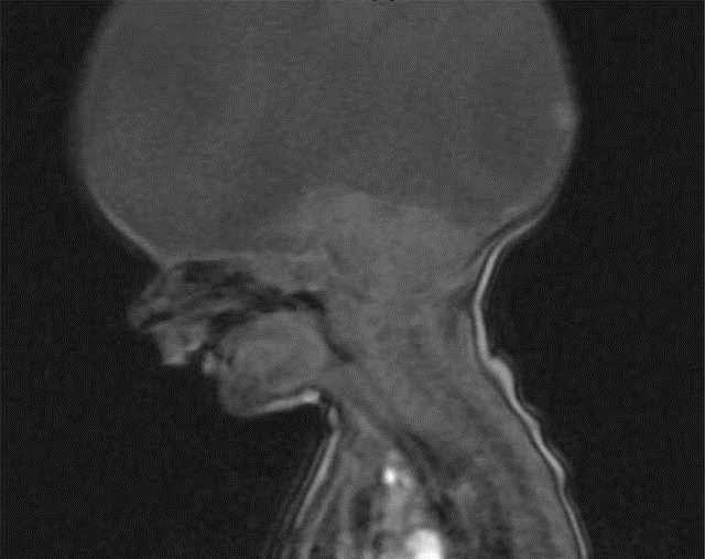 十月怀胎|婴儿天生没大脑,医生建议安乐死,如今被妈妈宠成小天使