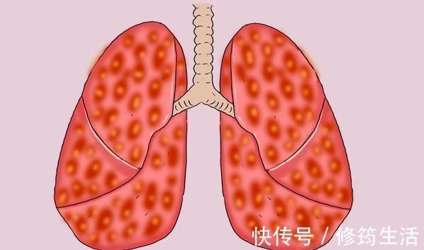 凌志军|07年查出肺癌晚期,现带癌生存17年,他分享了5条经验,值得借鉴