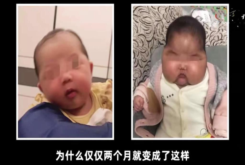 大头|新生儿两个月变“大头宝宝”,背后“凶手”竟是婴儿霜