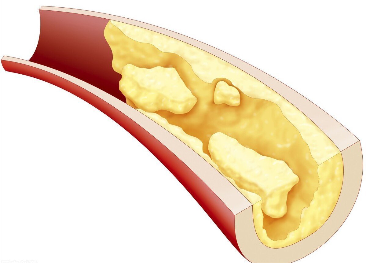 冠心病心绞痛|2个中成药,改善冠心病心绞痛,多靶点抗动脉粥样硬化,缩小斑块