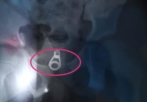 家长|为救六岁女童医生小心翼翼，家长一定不要额外损伤