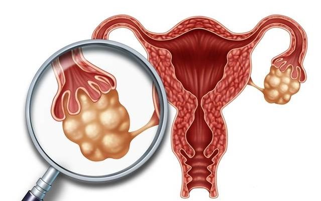 乳腺结节|体检查出结节、囊肿的你，是不是彻夜难眠？