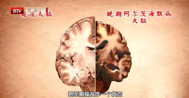 神经|老年痴呆居然有20年的潜伏期！揪出破坏脑神经的“元凶”，让大脑重回年轻！