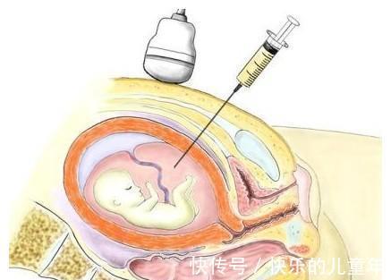 检查|唐氏儿最易找上两种宝妈，做好3种检查，帮孕妇避开唐氏风险
