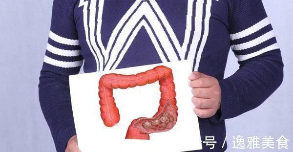 大肠癌|为什么大肠癌容易被误诊身体有4个表现,或是肠癌“预警信号”