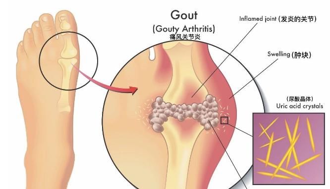  双脚|患痛风四十年长痛风石双脚难下地，他在求医降尿酸时遭遇了什么？