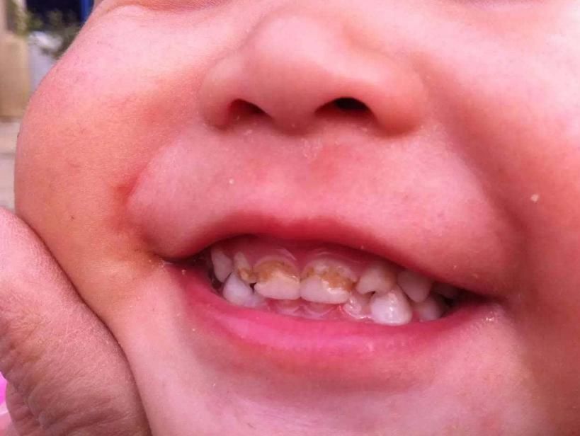 牙齿|4岁孩子一嘴黑牙,妈妈毫不在意认为牙齿能换,牙医叹气无知