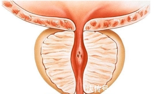 前列腺炎|男士有这3种情况,或是前列腺炎来了