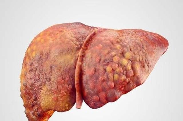 患者|肝癌的扩散速度有多快医生提醒三招预防让肝无忧