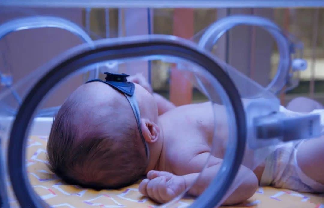 病理性黄疸|新生儿为什么会出现黄疸?该如何应对?关于黄疸你想知道的在这里