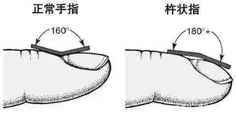 一天一包烟，若出现这4个迹象，说明你的肺已经受损，需戒烟了