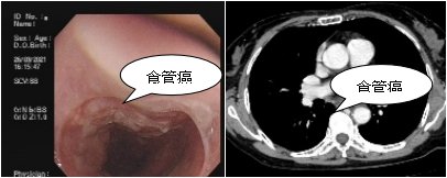 纵隔肿瘤|智慧长沙：食管癌、肺癌、纵隔肿瘤，复杂胸部肿瘤全中招 70多岁娭毑经高难度手术化险为夷