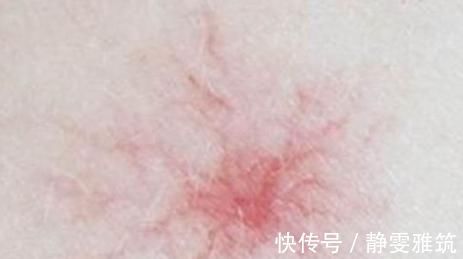 黄疸|“肝脏”若变硬了，身体会亮起“4盏灯”，愿你别假装看不见