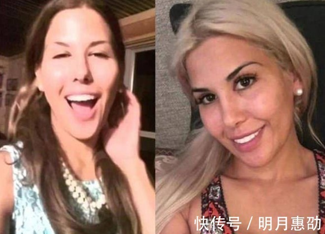整容手术|女子花重金整容,一年经历13次整容手术,整容前后判若两人