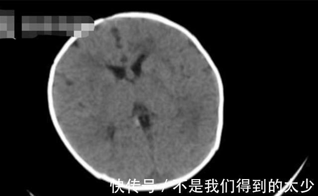 缺乏症|新生儿也会突发脑出血?或因这个“陋习”所致,宝妈们赶紧自查