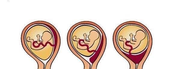 胎盘|剖腹产最多剖几次？第3次剖腹产危险大吗？这些答案孕妇得搞清楚