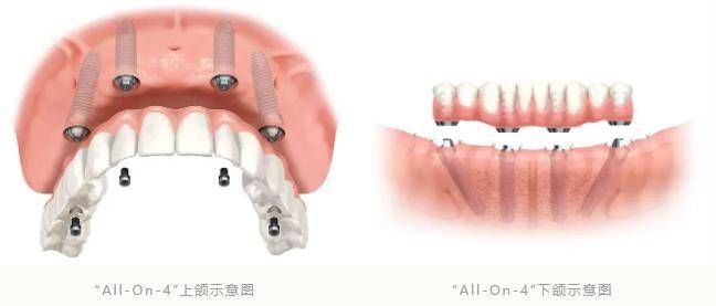 美莱|杭州美莱口腔健康科普：父母嘴里还剩几颗健康牙齿，你清楚吗？