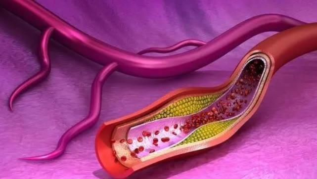 听力|3个信号发出预警,血脂已超过“警戒线”!做好4事,血脂稳稳的