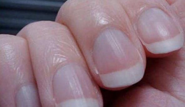 灰指甲|指甲上竖纹增多变黑怎么回事?可能是这4个问题,请自查一下!