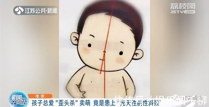 颈部|孩子总爱“歪头杀”卖萌?小心!可能是得了这种病
