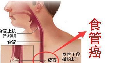 喉咙出现这2种症状要注意，别错把食管癌当成咽喉炎