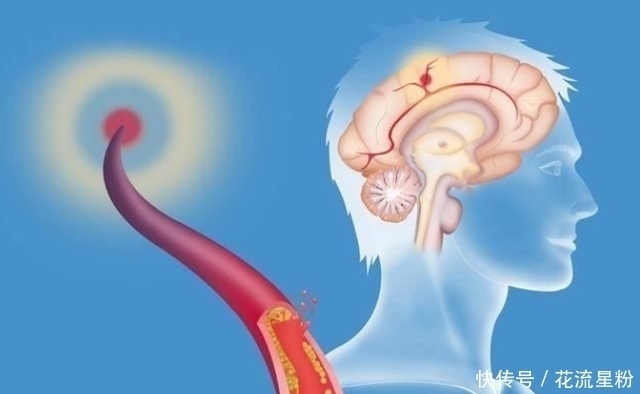 脑梗死|脑梗“悄无声息”?身体的4个暗示,不妨注重脑血管养护,别大意