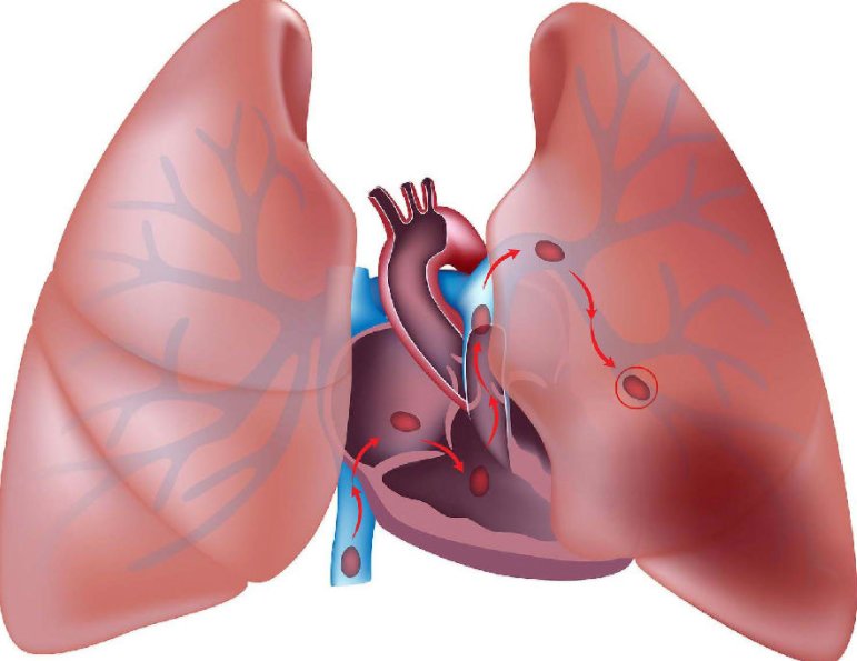 胸闷|以为是哮喘复发，没想到是凶险万分的肺动脉栓塞