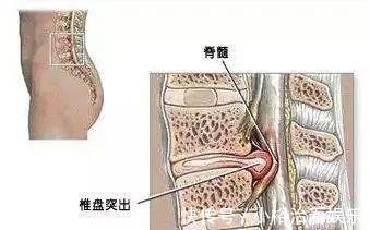 腰椎间盘突出|一个小土方,消除腰间盘突出很简单,一用一个好!