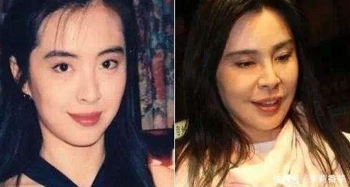 鼻梁|长期注射玻尿酸的人,皮肤会撑开变松弛?专业整形顾问告诉你