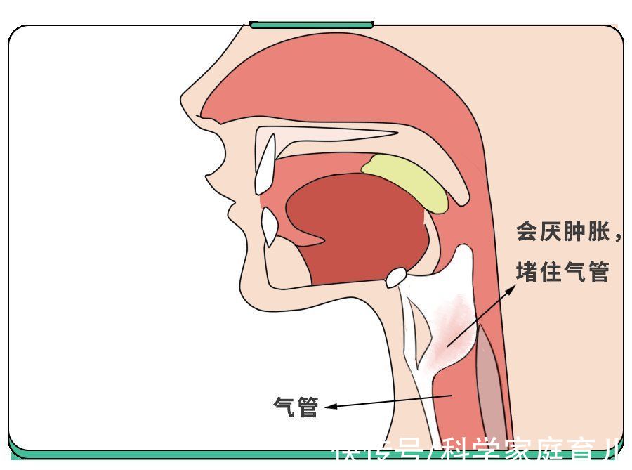 会厌|孩子疼到窒息，重症率高，小孩大人都得防，注意这几点