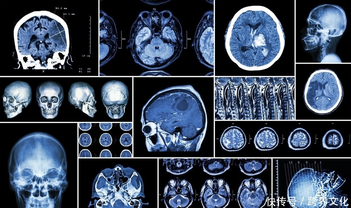 预防复发|为什么脑梗死容易复发?预防脑梗死复发,有什么方法呢?